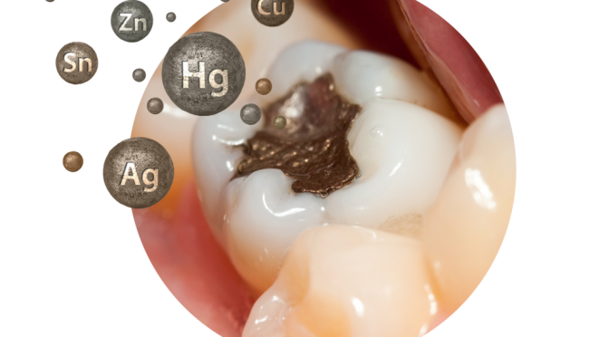 Amalgam